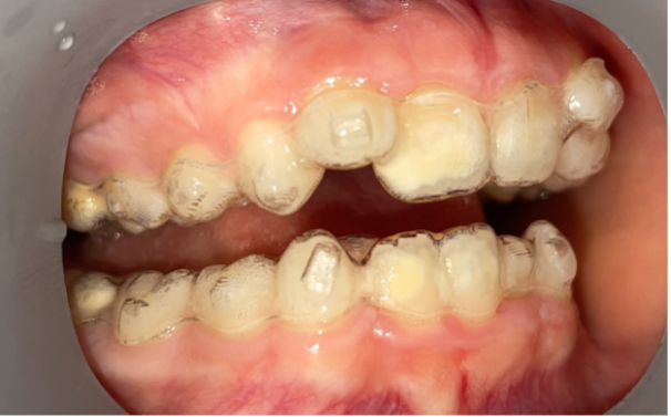 Phase 1 Orthodontic Treatment with Invisalign for children in Buffalo Grove, IL